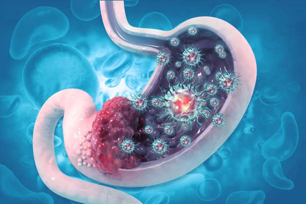 Stomach cancer diagnosis and staging involve diverse medical techniques.